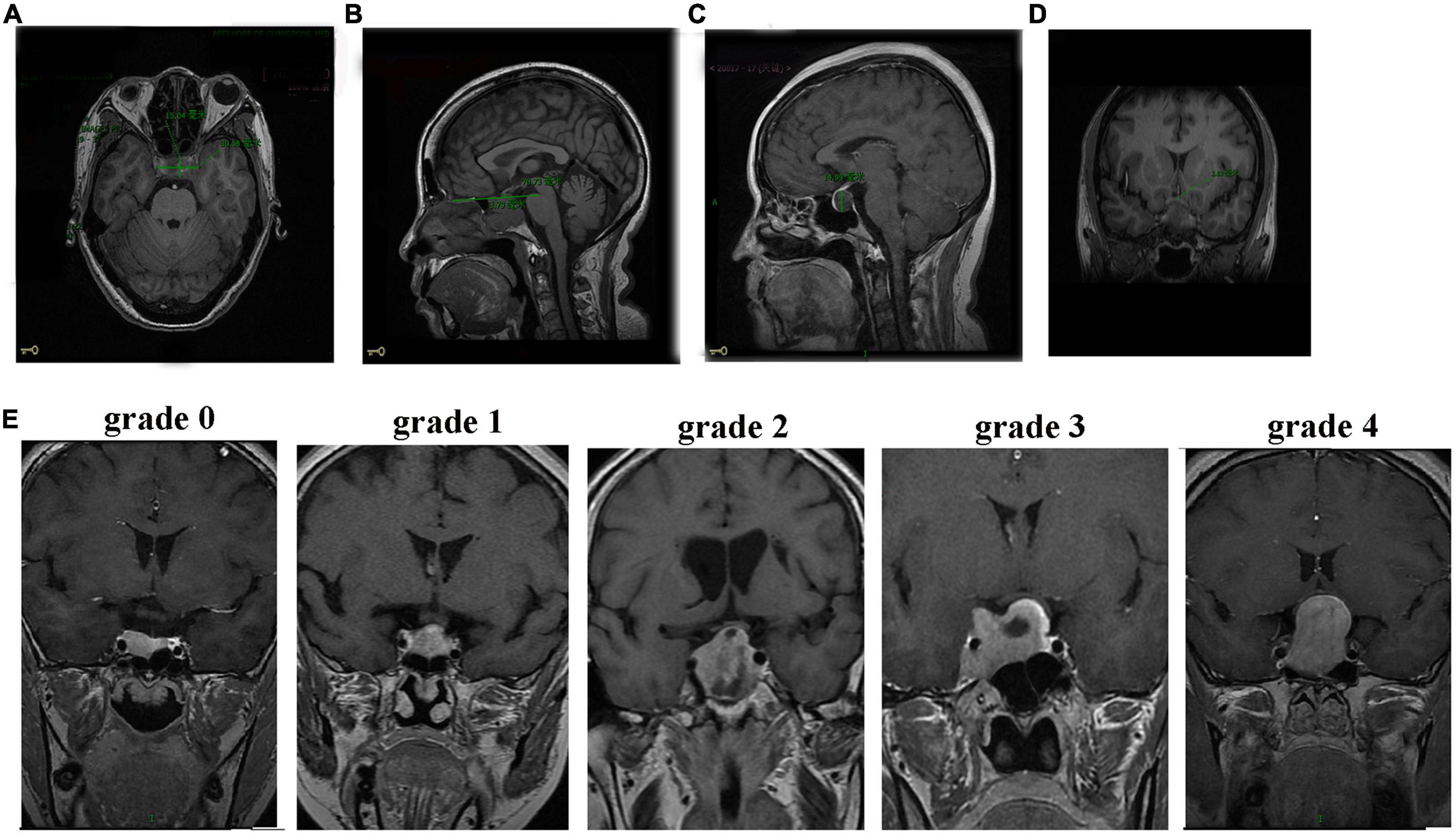Evaluation of preoperative visual pathway impairment in patients with non-functioning pituitary adenoma using diffusion tensor imaging coupled with optical coherence tomography